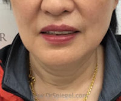 Facetite / Necktite / Embrace / Accutite Before & After Gallery - Patient 137555 - Image 1