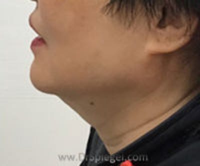 Facetite / Necktite / Embrace / Accutite Before & After Gallery - Patient 137555 - Image 3
