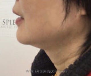 Facetite / Necktite / Embrace / Accutite Before & After Gallery - Patient 137555 - Image 4