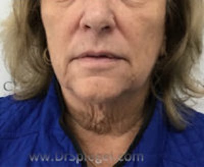 Facetite / Necktite / Embrace / Accutite Before & After Gallery - Patient 421291 - Image 1
