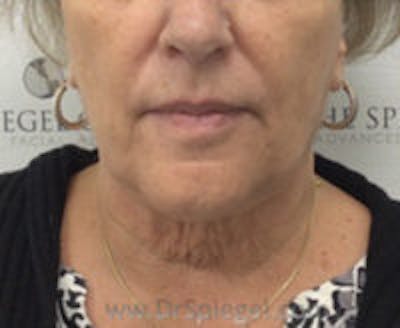 Facetite / Necktite / Embrace / Accutite Before & After Gallery - Patient 421291 - Image 2
