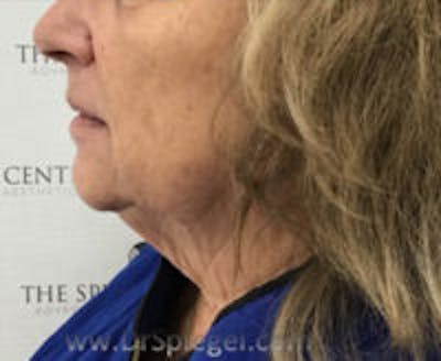 Facetite / Necktite / Embrace / Accutite Before & After Gallery - Patient 421291 - Image 3