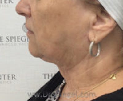 Facetite / Necktite / Embrace / Accutite Before & After Gallery - Patient 421291 - Image 4