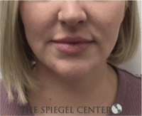 Facetite / Necktite / Embrace / Accutite Before & After Gallery - Patient 240331 - Image 1