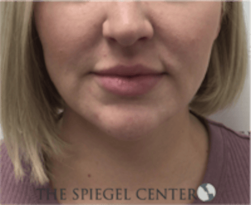 Facetite / Necktite / Embrace / Accutite Before & After Gallery - Patient 240331 - Image 1