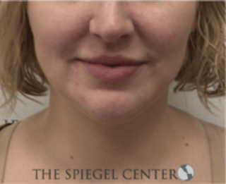 Facetite / Necktite / Embrace / Accutite Before & After Gallery - Patient 240331 - Image 2