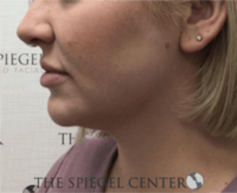 Facetite / Necktite / Embrace / Accutite Before & After Gallery - Patient 240331 - Image 3