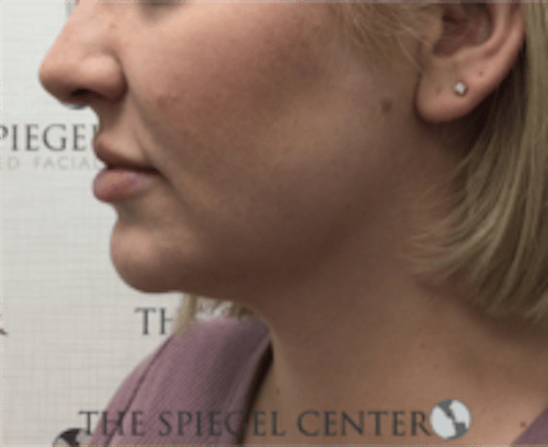 Facetite / Necktite / Embrace / Accutite Before & After Gallery - Patient 240331 - Image 3