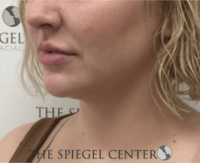 Facetite / Necktite / Embrace / Accutite Before & After Gallery - Patient 240331 - Image 4
