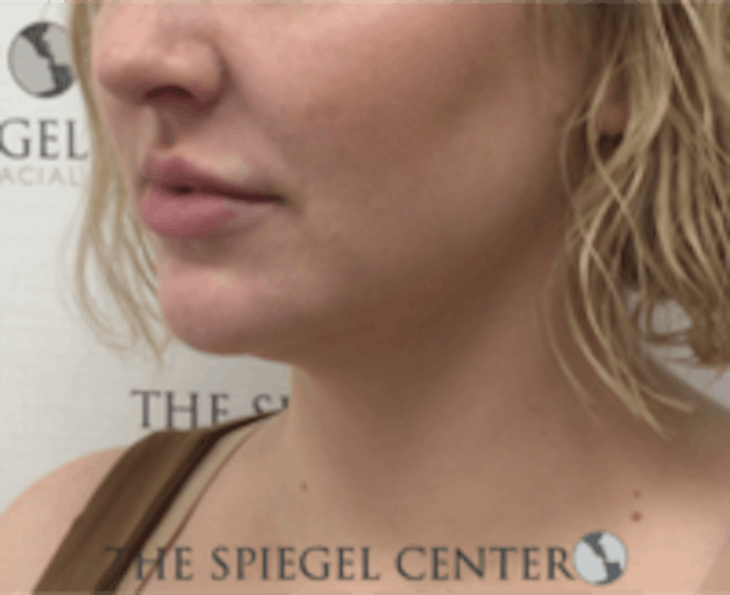 Facetite / Necktite / Embrace / Accutite Before & After Gallery - Patient 240331 - Image 4