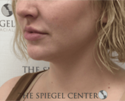 Facetite / Necktite / Embrace / Accutite Before & After Gallery - Patient 240331 - Image 4