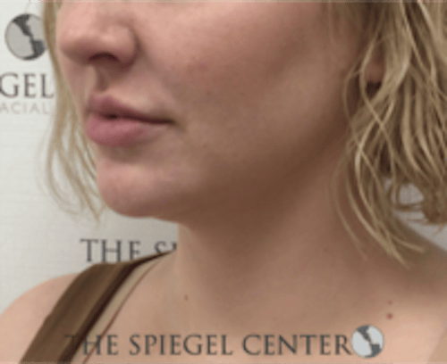 Facetite / Necktite / Embrace / Accutite Before & After Gallery - Patient 240331 - Image 4