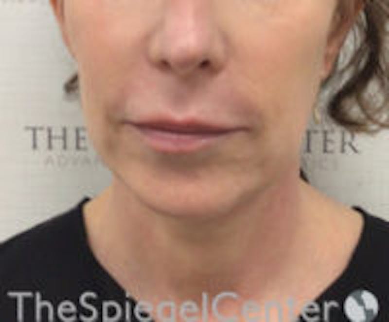 Facetite / Necktite / Embrace / Accutite Before & After Gallery - Patient 129382 - Image 1