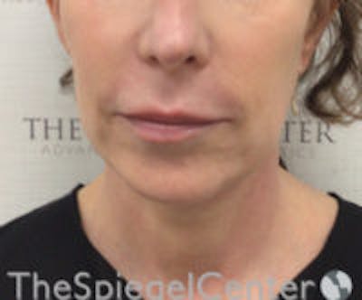 Facetite / Necktite / Embrace / Accutite Before & After Gallery - Patient 129382 - Image 1