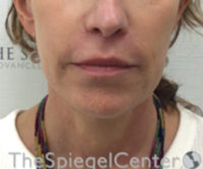 Facetite / Necktite / Embrace / Accutite Before & After Gallery - Patient 129382 - Image 2