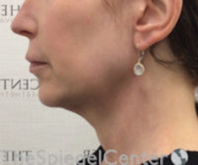 Facetite / Necktite / Embrace / Accutite Before & After Gallery - Patient 129382 - Image 3
