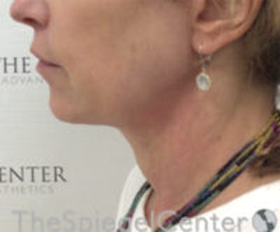 Facetite / Necktite / Embrace / Accutite Before & After Gallery - Patient 129382 - Image 4