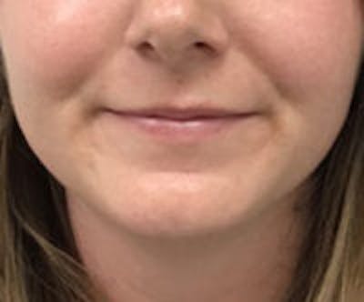 Facetite / Necktite / Embrace / Accutite Before & After Gallery - Patient 186145 - Image 1