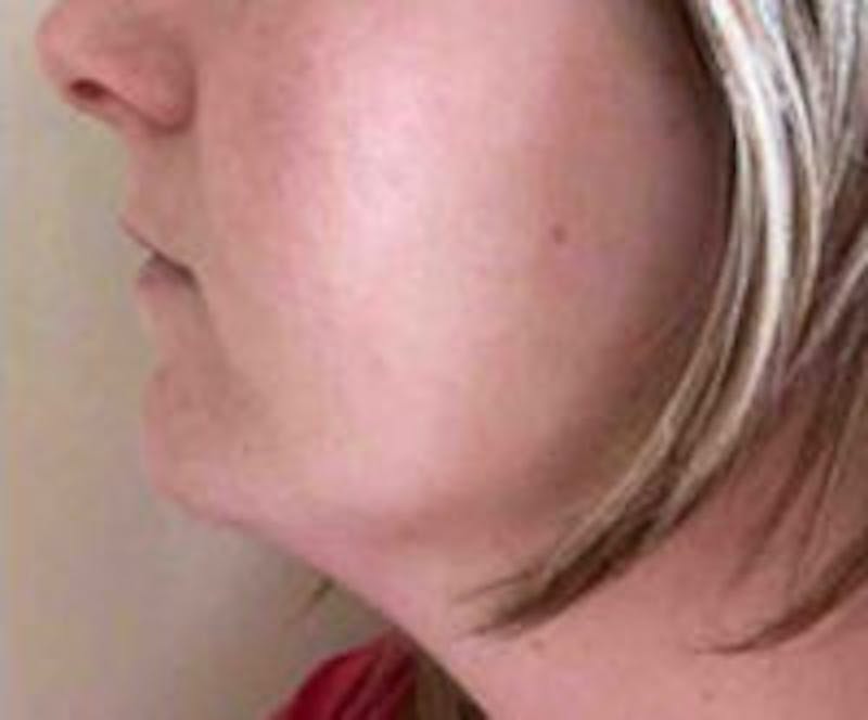 Facetite / Necktite / Embrace / Accutite Before & After Gallery - Patient 186145 - Image 3