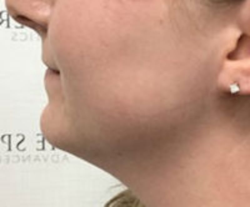 Facetite / Necktite / Embrace / Accutite Before & After Gallery - Patient 186145 - Image 4