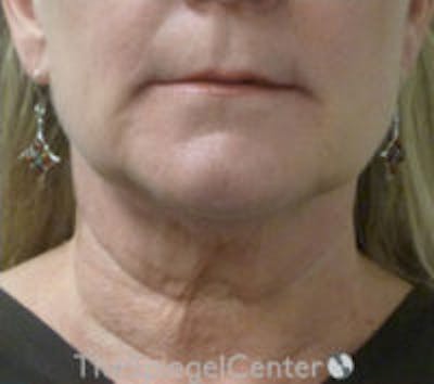 Facetite / Necktite / Embrace / Accutite Before & After Gallery - Patient 259593 - Image 1