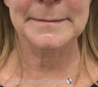 Facetite / Necktite / Embrace / Accutite Before & After Gallery - Patient 259593 - Image 2
