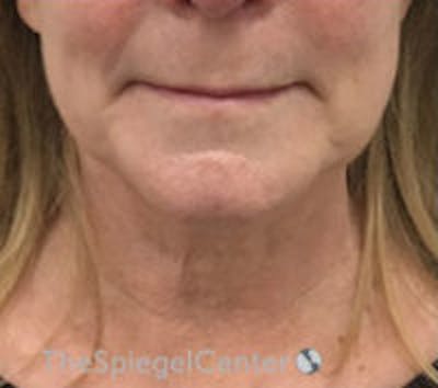 Facetite / Necktite / Embrace / Accutite Before & After Gallery - Patient 259593 - Image 2