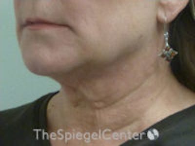 Facetite / Necktite / Embrace / Accutite Before & After Gallery - Patient 259593 - Image 3