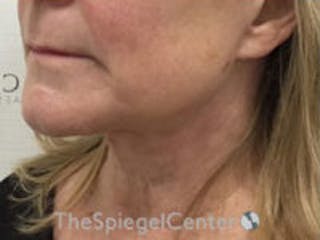 Facetite / Necktite / Embrace / Accutite Before & After Gallery - Patient 259593 - Image 4