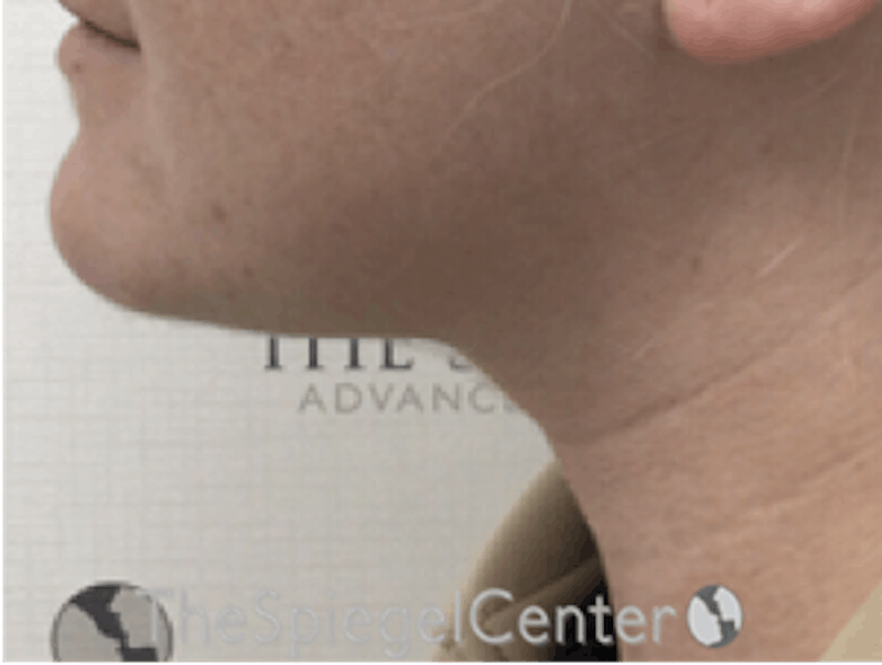 Facetite / Necktite / Embrace / Accutite Before & After Gallery - Patient 368713 - Image 4