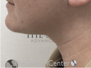 Facetite / Necktite / Embrace / Accutite Before & After Gallery - Patient 368713 - Image 4