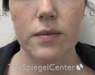 Facetite / Necktite / Embrace / Accutite Before & After Gallery - Patient 734296 - Image 1