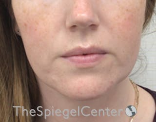 Facetite / Necktite / Embrace / Accutite Before & After Gallery - Patient 734296 - Image 2