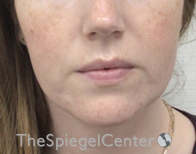 Facetite / Necktite / Embrace / Accutite Before & After Gallery - Patient 734296 - Image 2