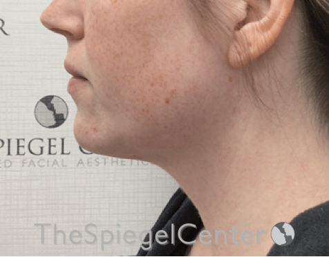 Facetite / Necktite / Embrace / Accutite Before & After Gallery - Patient 734296 - Image 3
