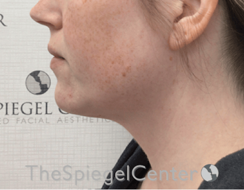 Facetite / Necktite / Embrace / Accutite Before & After Gallery - Patient 734296 - Image 3