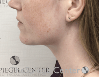 Facetite / Necktite / Embrace / Accutite Before & After Gallery - Patient 734296 - Image 4