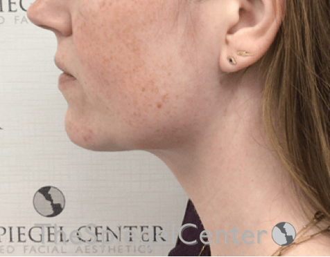 Facetite / Necktite / Embrace / Accutite Before & After Gallery - Patient 734296 - Image 4