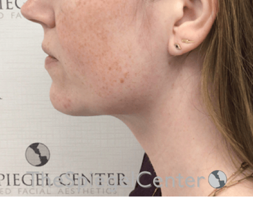 Facetite / Necktite / Embrace / Accutite Before & After Gallery - Patient 734296 - Image 4