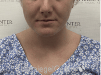 Facetite / Necktite / Embrace / Accutite Before & After Gallery - Patient 187532 - Image 1