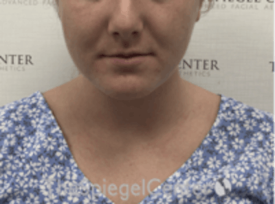 Facetite / Necktite / Embrace / Accutite Before & After Gallery - Patient 187532 - Image 1