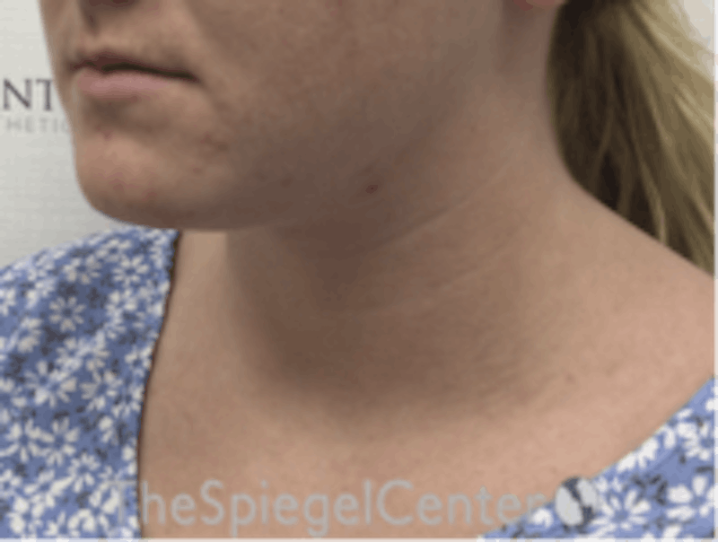 Facetite / Necktite / Embrace / Accutite Before & After Gallery - Patient 187532 - Image 3