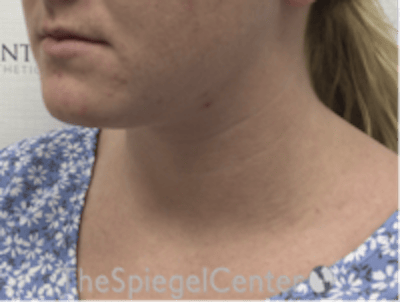 Facetite / Necktite / Embrace / Accutite Before & After Gallery - Patient 187532 - Image 3