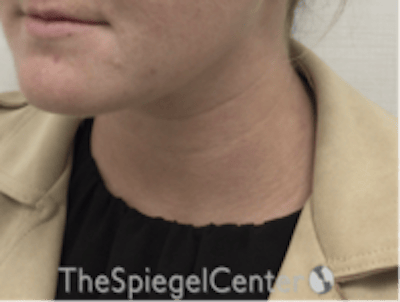 Facetite / Necktite / Embrace / Accutite Before & After Gallery - Patient 187532 - Image 4
