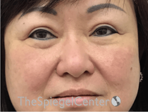 Facetite / Necktite / Embrace / Accutite Before & After Gallery - Patient 371139 - Image 1