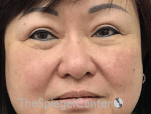 Facetite / Necktite / Embrace / Accutite Before & After Gallery - Patient 371139 - Image 1