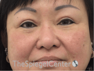 Facetite / Necktite / Embrace / Accutite Before & After Gallery - Patient 371139 - Image 2