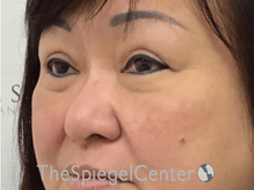 Facetite / Necktite / Embrace / Accutite Before & After Gallery - Patient 371139 - Image 3