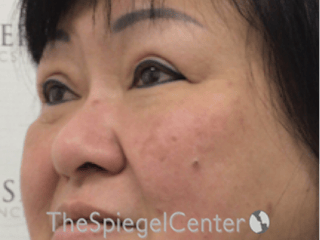 Facetite / Necktite / Embrace / Accutite Before & After Gallery - Patient 371139 - Image 4