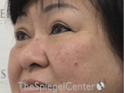 Facetite / Necktite / Embrace / Accutite Before & After Gallery - Patient 371139 - Image 4